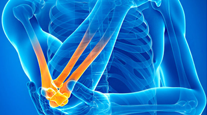 Newly understood protein raises hopes of advanced arthritis treatments